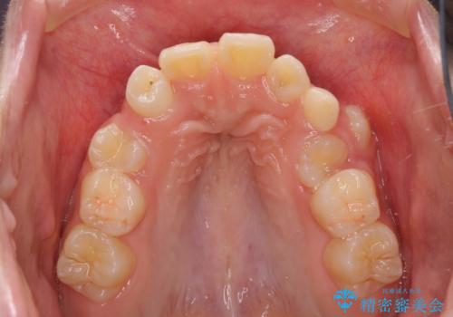 永久歯が生えてこない　ワイヤー矯正で複雑な状態を正常咬合へ誘導するの治療前