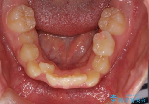 永久歯が生えてこない　ワイヤー矯正で複雑な状態を正常咬合へ誘導するの治療前