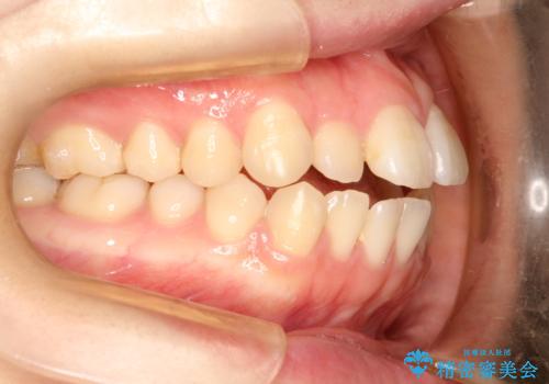 前歯がガタガタ・噛み切りにくい インビザラインによる歯を抜かない矯正の治療前