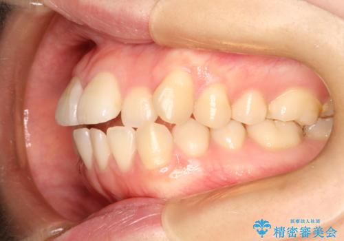 前歯がガタガタ・噛み切りにくい インビザラインによる歯を抜かない矯正の治療前