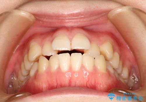 前歯がガタガタ・噛み切りにくい　インビザラインによる歯を抜かない矯正の治療前