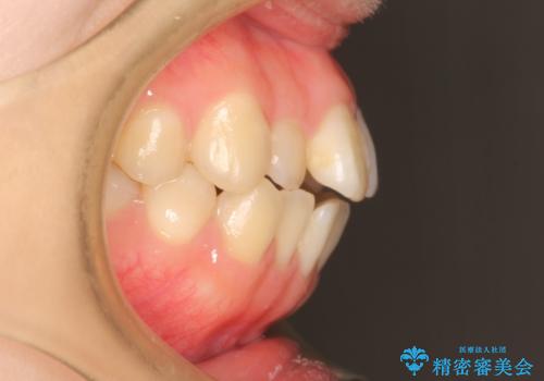 前歯がガタガタ・噛み切りにくい　インビザラインによる歯を抜かない矯正の治療前