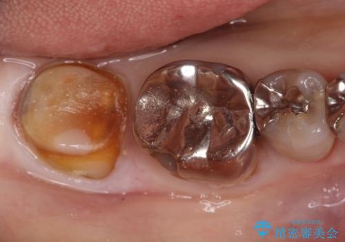 セラミッククラウンによるむし歯治療の治療中