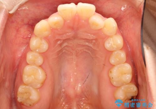 前歯がガタガタ・噛み切りにくい インビザラインによる歯を抜かない矯正の治療前