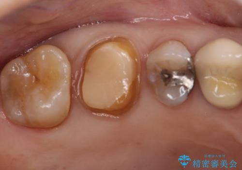 セラミッククラウンによるむし歯治療の治療中