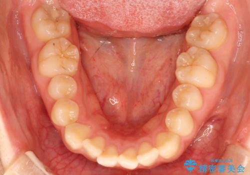 前歯がガタガタ・噛み切りにくい インビザラインによる歯を抜かない矯正の治療前