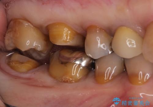 セラミッククラウンによるむし歯治療の治療中
