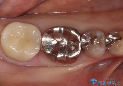 セラミッククラウンによるむし歯治療の治療後