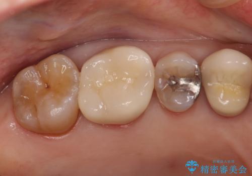 セラミッククラウンによるむし歯治療の治療後