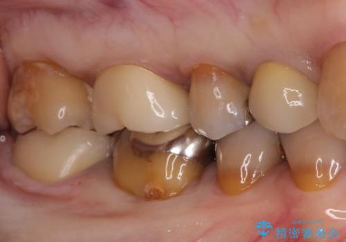 セラミッククラウンによるむし歯治療の治療後