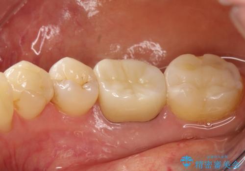咬んだ時の違和感 顕微鏡で発見された歯の穴を処置し、かみ合わせを回復するの治療後