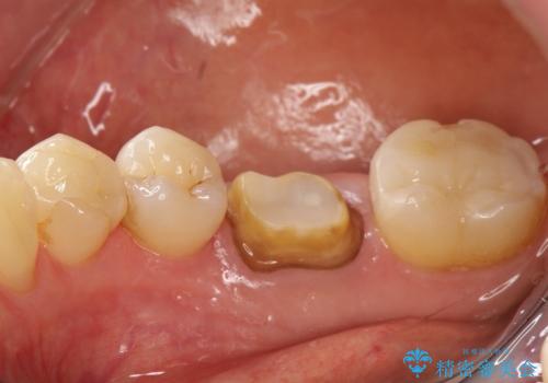 咬んだ時の違和感　顕微鏡で発見された歯の穴を処置し、かみ合わせを回復するの治療中