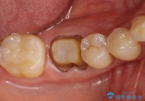 咬んだ時の違和感 顕微鏡で発見された歯の穴を処置し、かみ合わせを回復するの治療中