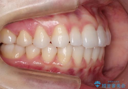 インビザラインで出っ歯を改善する　抜歯をしないinvisalign治療の治療後