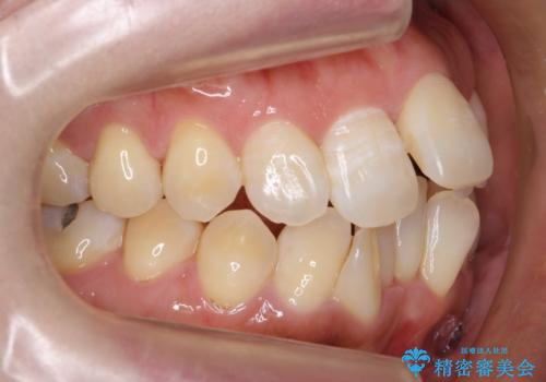 40代女性 前歯の重なり あきらめずに矯正の治療前