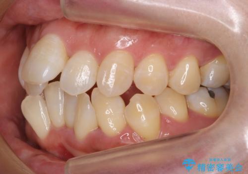 40代女性　前歯の重なり　あきらめずに矯正の治療前