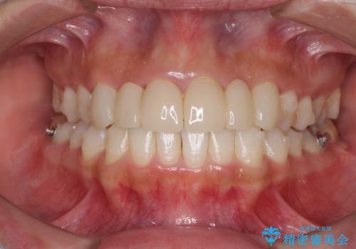 気になる前歯を審美歯科治療と矯正歯科治療で美しくの治療中