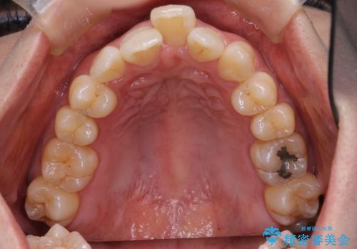 40代女性　前歯の重なり　あきらめずに矯正の治療前