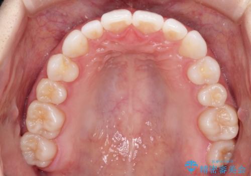 インビザラインで出っ歯を改善する　抜歯をしないinvisalign治療の治療後