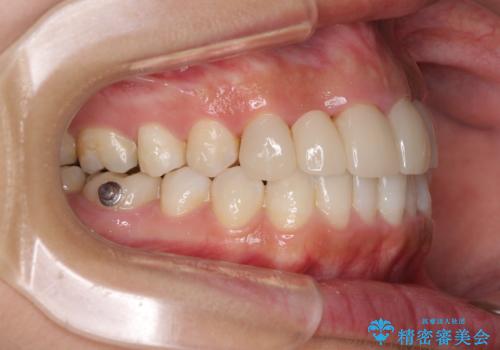 気になる前歯を審美歯科治療と矯正歯科治療で美しくの治療中