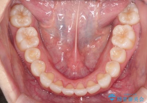 インビザラインで出っ歯を改善する　抜歯をしないinvisalign治療の治療後