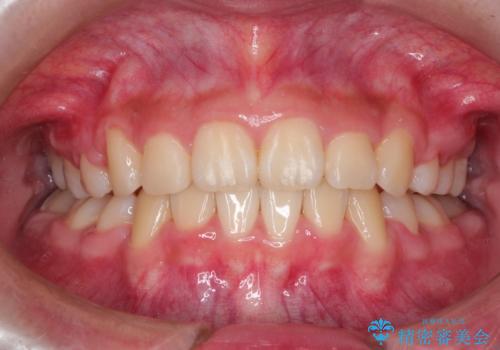 抜歯矯正で口元に変化を ラビアル・ワイヤー矯正でEラインの治療後