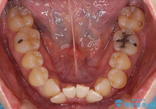 40代女性 前歯の重なり あきらめずに矯正の治療前