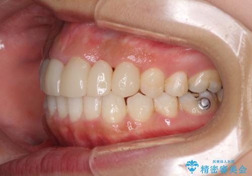 気になる前歯を審美歯科治療と矯正歯科治療で美しくの治療中