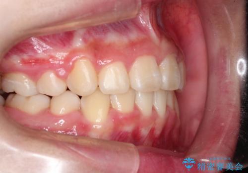 抜歯矯正で口元に変化を ラビアル・ワイヤー矯正でEラインの治療後