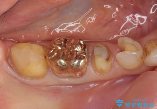 オールセラミッククラウン PGA(ゴールド)クラウン 古い銀歯の治療の治療中