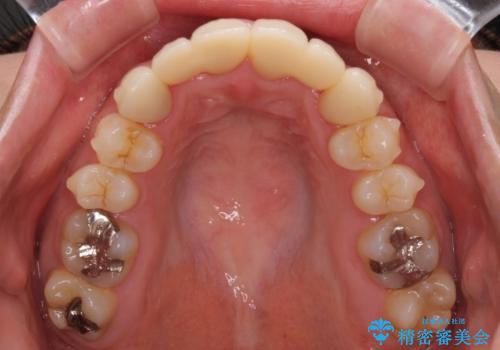 気になる前歯を審美歯科治療と矯正歯科治療で美しくの治療中