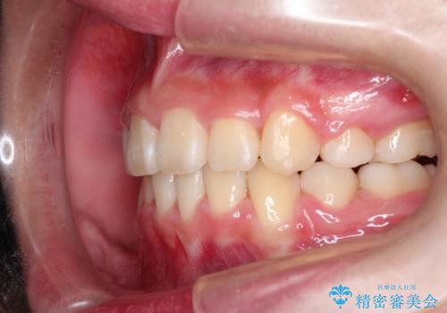 抜歯矯正で口元に変化を ラビアル・ワイヤー矯正でEラインの治療後