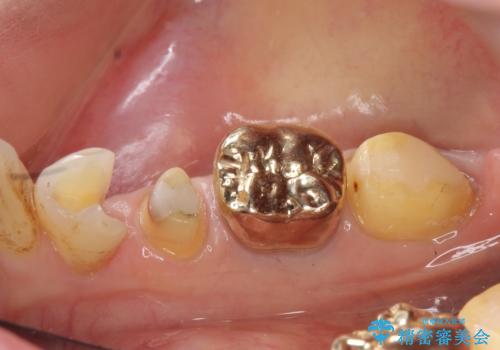 オールセラミッククラウン　PGA(ゴールド)クラウン　古い銀歯の治療の治療中