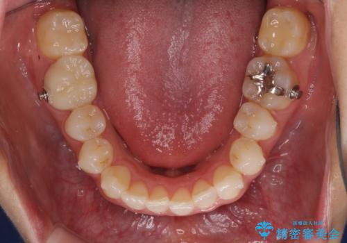 気になる前歯を審美歯科治療と矯正歯科治療で美しくの治療中