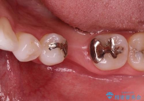 深い虫歯により抜歯となった奥歯 インプラント治療でかみ合わせを回復するの治療中