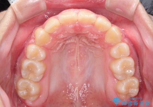 抜歯矯正で口元に変化を ラビアル・ワイヤー矯正でEラインの治療後