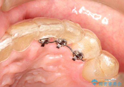 インビザライン invisalign ガタつきを治すマウスピース矯正の治療中