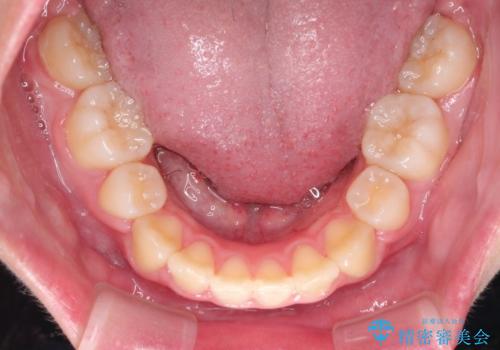 抜歯矯正で口元に変化を ラビアル・ワイヤー矯正でEラインの治療後