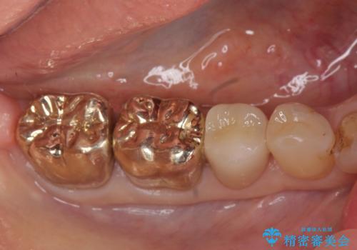 オールセラミッククラウン　PGA(ゴールド)クラウン　古い銀歯の治療の症例 治療後