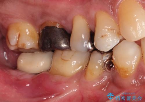奥歯が痛い。骨増生を併用したインプラントの治療後
