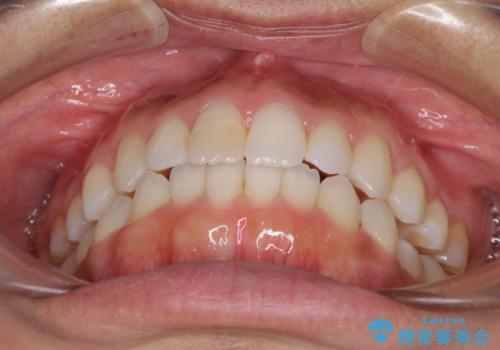 前歯の叢生を治したい インビザラインによる矯正治療の治療後