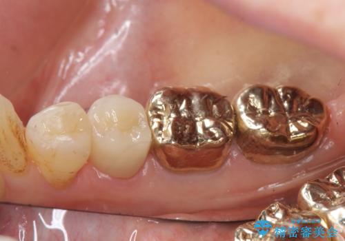 オールセラミッククラウン　PGA(ゴールド)クラウン　古い銀歯の治療の治療後