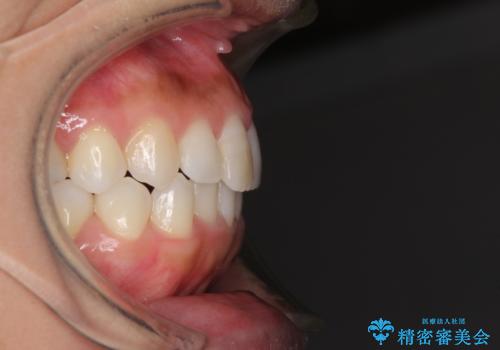 前歯の叢生を治したい インビザラインによる矯正治療の治療後