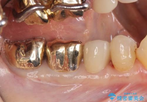 オールセラミッククラウン PGA(ゴールド)クラウン 古い銀歯の治療の治療後