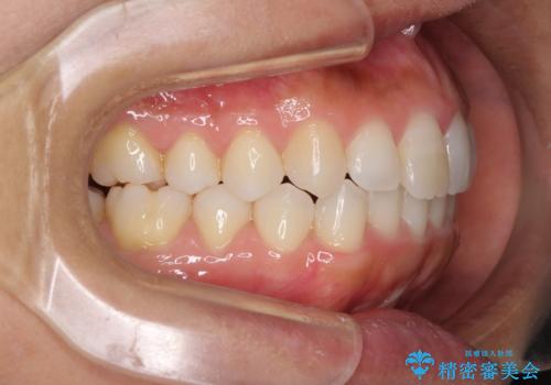 前歯の叢生を治したい インビザラインによる矯正治療の治療後