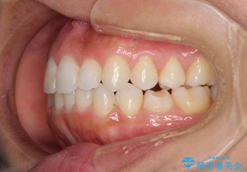 前歯の叢生を治したい　インビザラインによる矯正治療の治療後