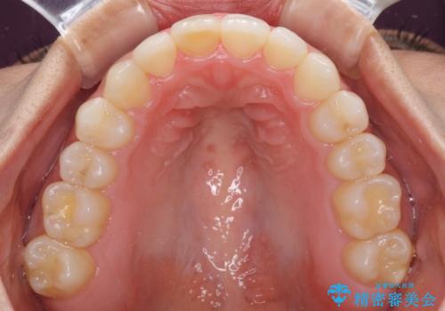 前歯の叢生を治したい インビザラインによる矯正治療の治療後