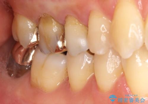 一番奥歯の後ろに虫歯が　処置の難しい虫歯の治療前