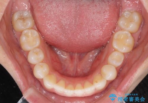 前歯の叢生を治したい インビザラインによる矯正治療の治療後