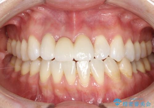 前歯がぐらぐらする　抜歯→ブリッジへ　の症例 治療後